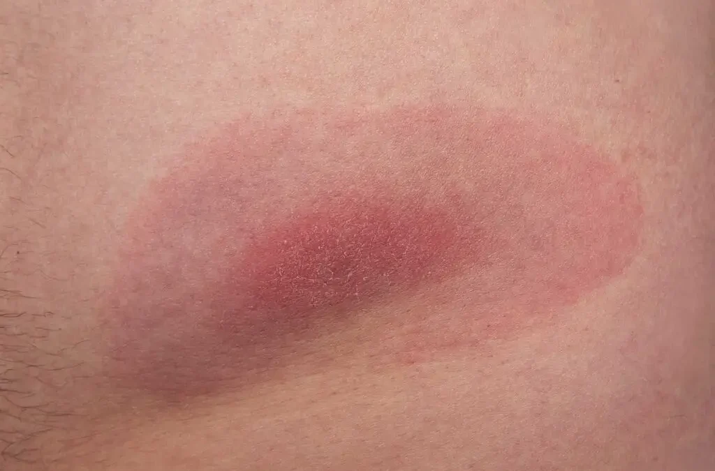 It’s time to take Lyme seriously