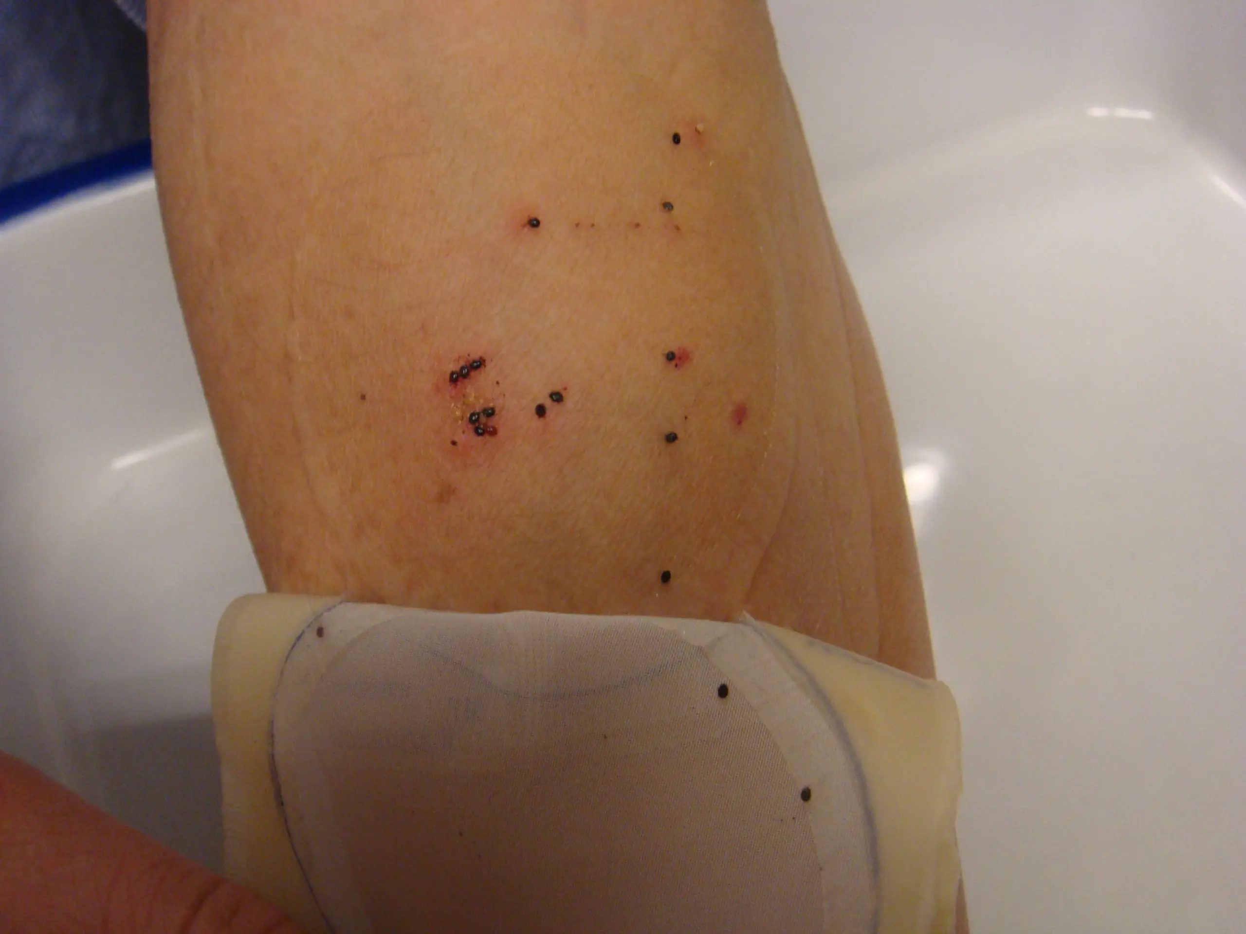 Feeding Ticks on People: Ticks as a diagnostic tool