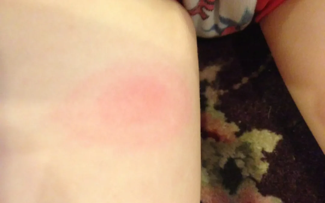 Human Testing Begins On Springtime Lyme Disease Shot Developed In Mass.