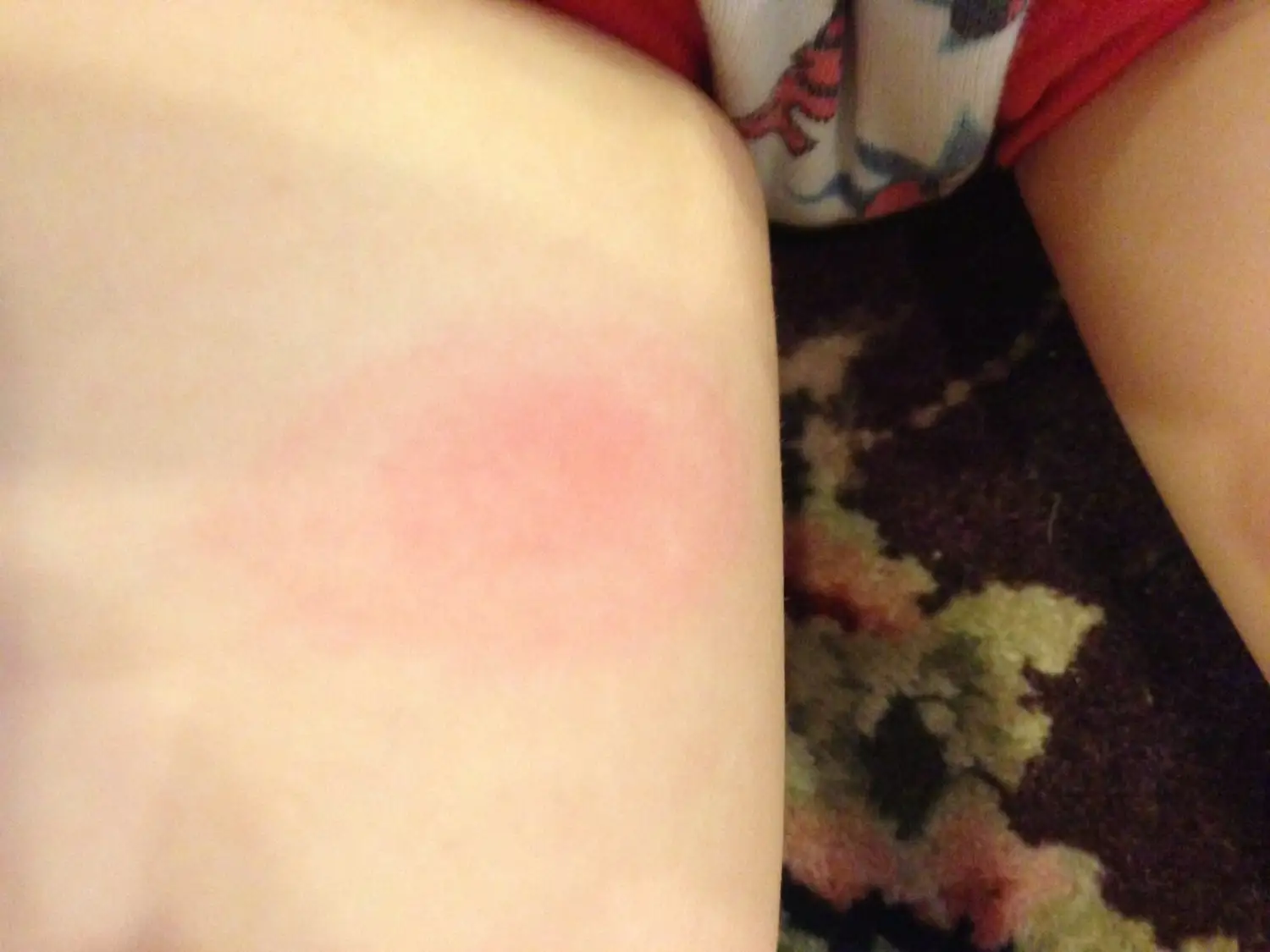 Human Testing Begins On Springtime Lyme Disease Shot Developed In Mass.