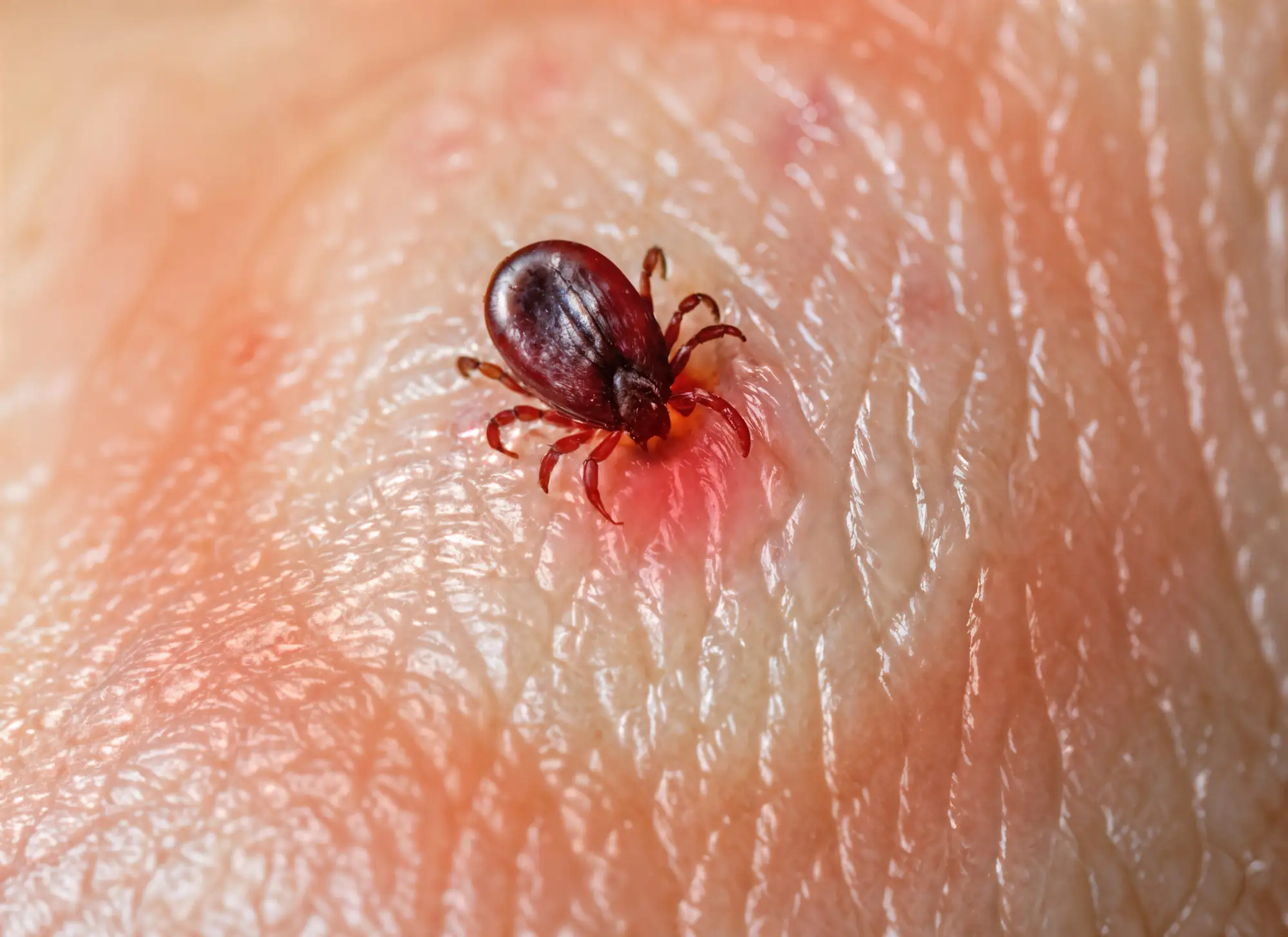 Dogs can get a Lyme disease vaccine. Why can’t humans?